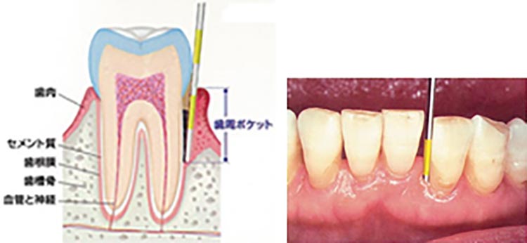 歯周ポケット検査の参考画像